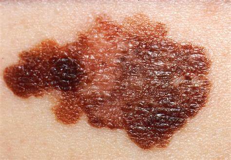 El cáncer de piel triplica su incidencia desde la década de los noventa